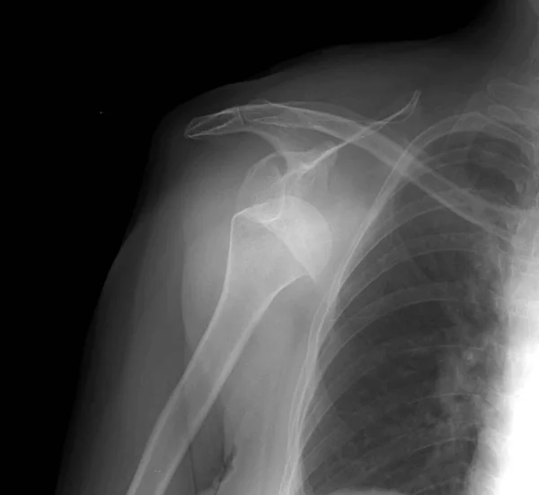 Röntgenbild Einer Verrenkten Schulter Bei Der Sich Der Oberarmkopf Vom — Stockfoto