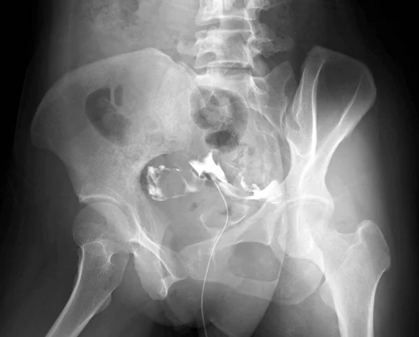 Histerosalpingografía Derecha Radiografía Una Mujer Años Con Infertilidad Durante Años —  Fotos de Stock