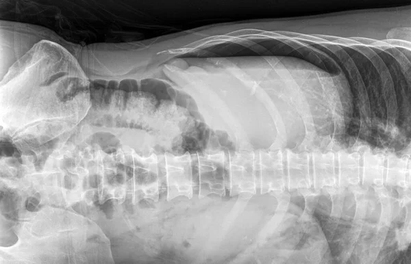 腹痛患者腹部X线平侧左十二指肠 Lld 其肝脏上方呈月牙形辐射状病变 提示有气腹的症状 — 图库照片
