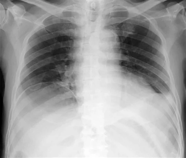 Рентген Грудной Клетки Пациента Показывающий Полумесяц Радиоактивное Повреждение Диафрагмой Напоминающей — стоковое фото