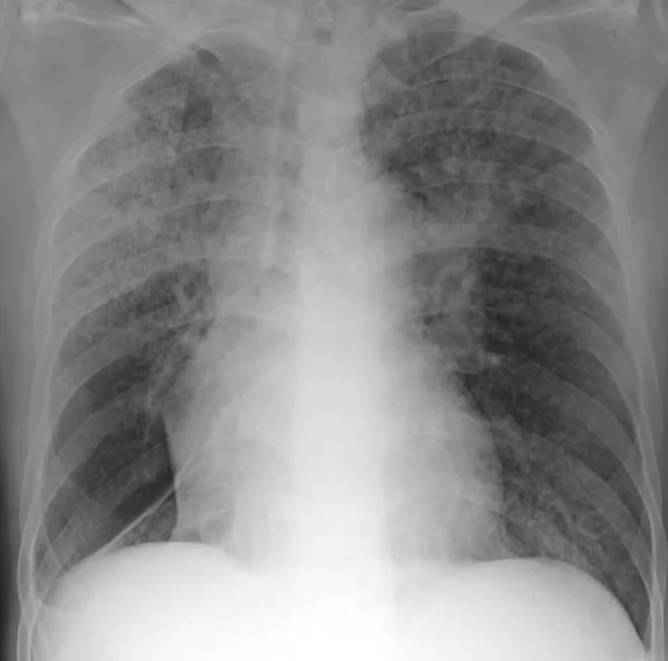 Röntgenbild Eines Patienten Mit Miliären Knötchen Military Bezieht Sich Auf — Stockfoto