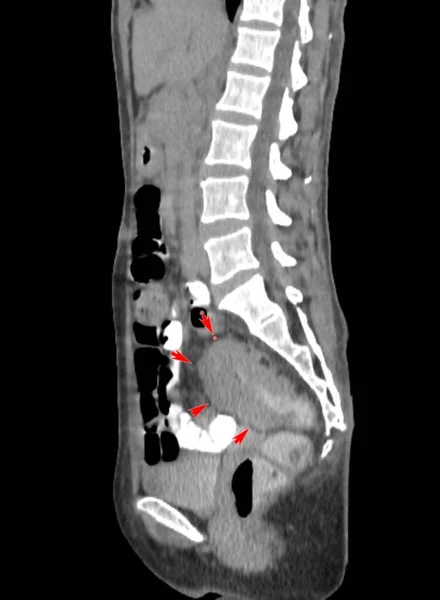 直肠癌患者的矢状Ct扫描显示肠壁增厚 病人患有慢性腹泻和贫血症 — 图库照片