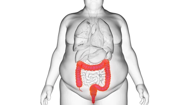 Παχέος Εντέρου Του Παχύσαρκου Ανθρώπου Εικόνα — Φωτογραφία Αρχείου