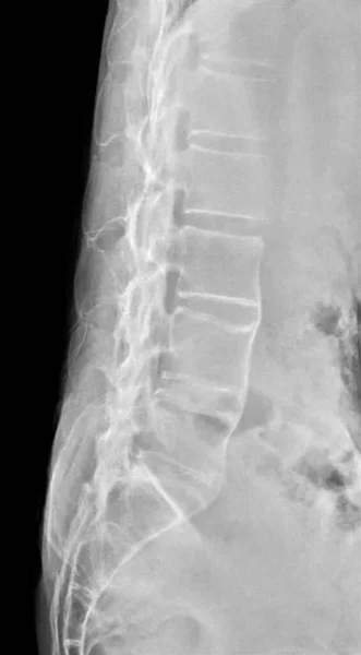 Röntgenbild Der Unteren Lumbarsacralen Wirbelsäule Eines Patienten Mit Ankylose Spondylitis — Stockfoto