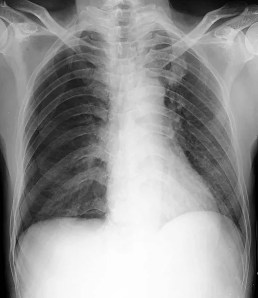 Radiographie Pulmonaire Montrant Pneumonthorax Droit Espace Libre Dans Hémithorax Droit — Photo