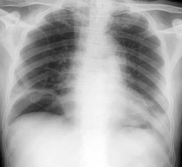 肺炎を示唆する図の下に三日月形の放射性降下物の病変を示す患者の胸部X線 空気圧とは 腹膜腔内に空気が存在することをいう — ストック写真
