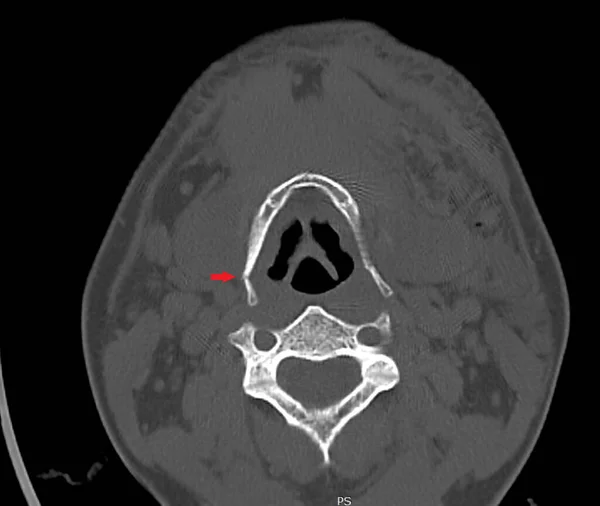 一名26岁男性道路交通意外中骨折的透明质骨 中上部 患者颈部电脑断层扫描 — 图库照片