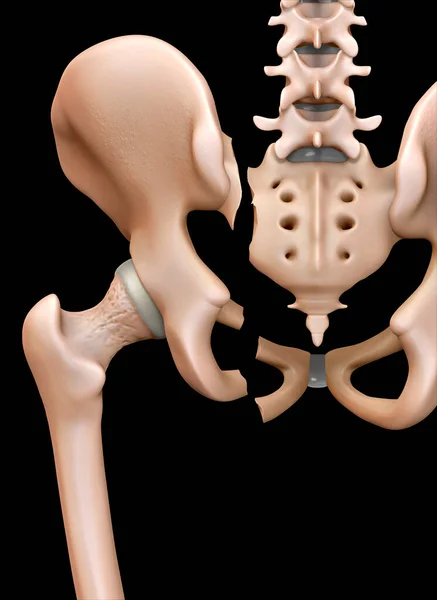 Illustration Showing Rear View Fractured Pelvis — Stock Photo, Image