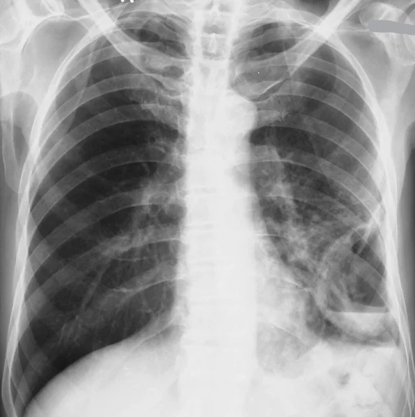 Akciğer Apsesinin Göğüs Röntgeni Apse Dokudaki Boşlukta Bulunan Bir Kedi — Stok fotoğraf