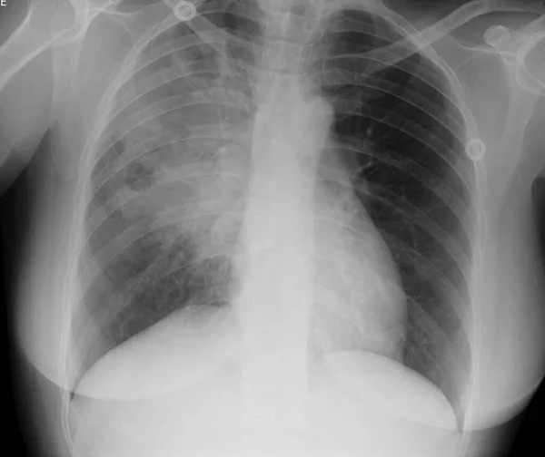 肺脓肿的胸部X光检查 脓肿是组织腔内的积液 它通常是由感染或其他外来物质引起的 — 图库照片