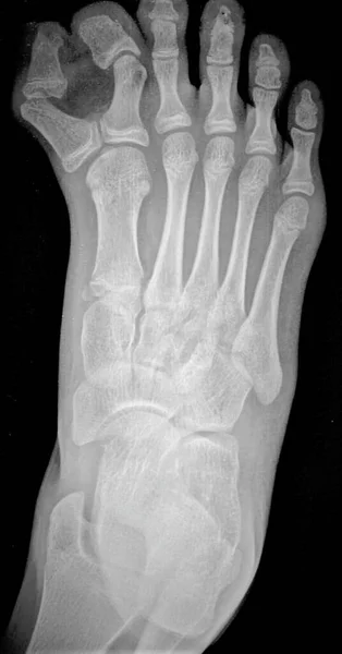 多趾畸形 一种先天性 出生时在场 被称为多趾畸形的病人的脚部X光检查 — 图库照片