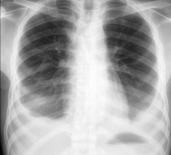 Röntgenbild Der Brust Eines Patienten Mit Pleuraerguss Pleuraerguss Ist Die — Stockfoto