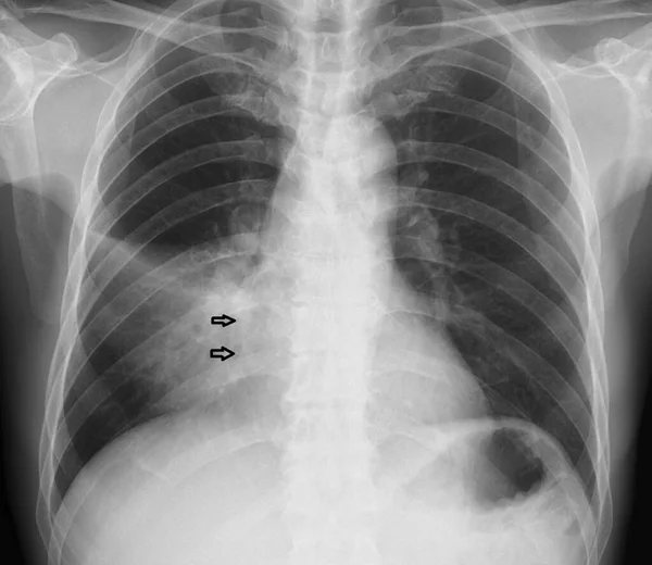 Röntgenbild Das Ein Silhouettenzeichen Zeigt Das Einen Verlust Klarer Bruststrukturen — Stockfoto