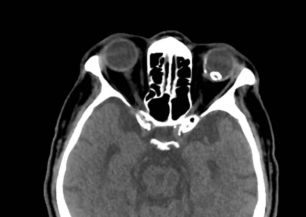 Tomografia Computerizzata Scansione Della Testa Paziente Con Una Lente Lussata — Foto Stock