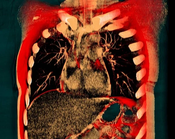 Sağlıklı Akciğerlerin Boyutlu Bilgisayarlı Tomografi Taraması — Stok fotoğraf