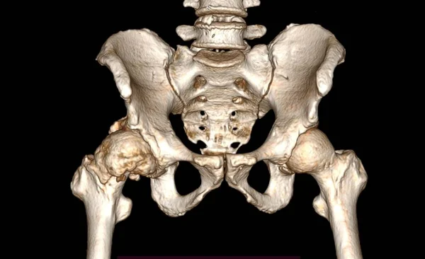 右髋关节骨关节炎的Ct扫描显示股骨头和髋臼不规则 骨关节炎是一种因机械应力而加重的关节疾病 症状包括关节疼痛 僵硬和肿胀 在严重的情况下 — 图库照片