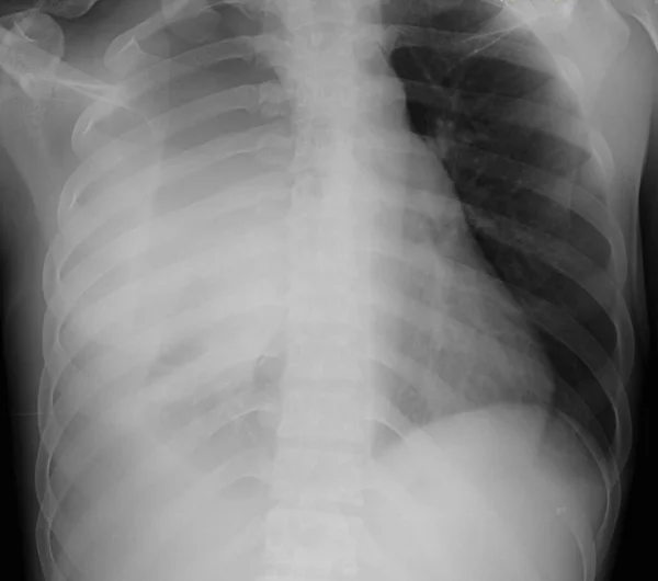 胸前のX線は胸水患者を示しています 胸水は肺のまわりのスペースの液体の蓄積である 液体は肺を圧縮し 呼吸困難につながります — ストック写真