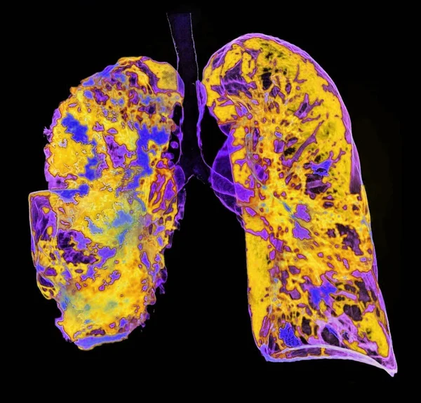 Tomografia Computadorizada Colorida Tórax Paciente Com Pneumonia Que Afeta Pulmão — Fotografia de Stock