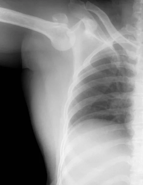 Röntgenbild Einer Verrenkten Schulter Dabei Handelt Sich Eine Minderwertige Dislokation — Stockfoto