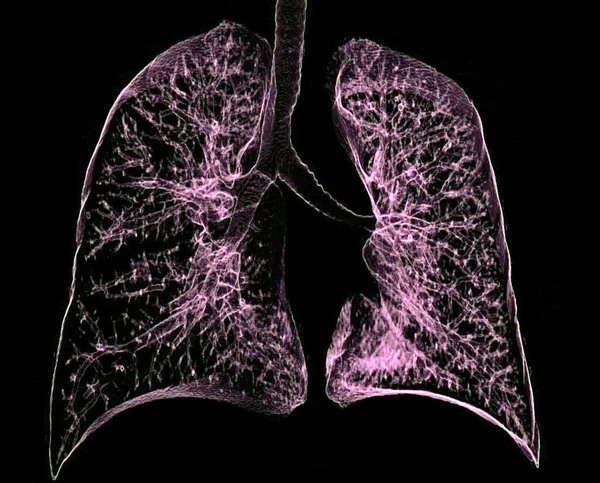 Sağlıklı Akciğerlerin Renkli Koronal Bilgisayarlı Tomografi Taraması Akciğerler Karbondioksitin Kandan — Stok fotoğraf