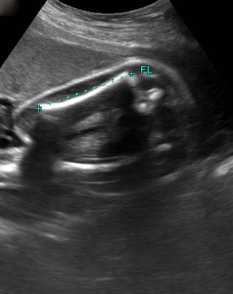 超声扫描测量胎儿30周时股骨 大腿骨 的长度 在这一阶段 胎儿的平均长度为40厘米 重量约1 3公斤 — 图库照片