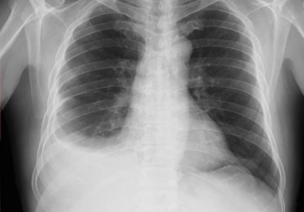 Chest Ray Patient Showing Pleural Effusion Accumulation Fluid Spaces Lungs — Stock Photo, Image