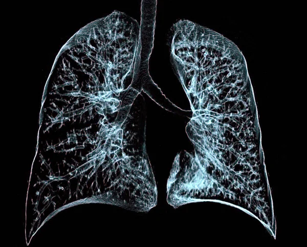 Tac Tomografia Computerizzata Coronale Colorata Polmoni Sani Polmoni Sono Sito — Foto Stock