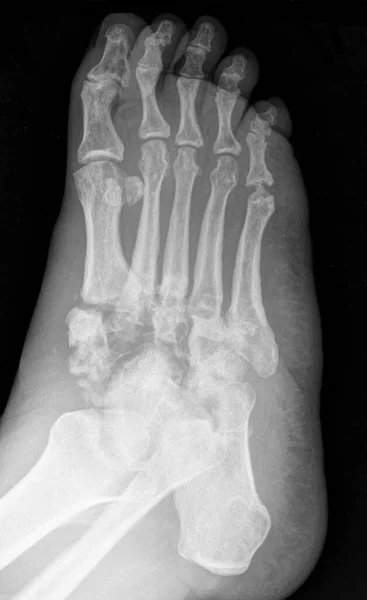 Radiografía Del Pie Paciente Con Osteomielitis Del Tobillo Osteomielitis Una —  Fotos de Stock