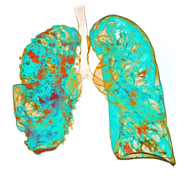 Coloured Computed Tomography Scan Chest Patient Pneumonia Affecting Right Lung — Stock Photo, Image