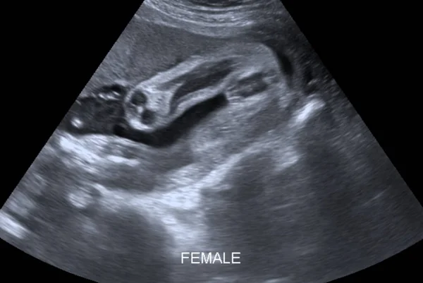 Ultrasound Scan Female Foetus Weeks Average Foetuses Measure Centimetres Length — Stock Photo, Image