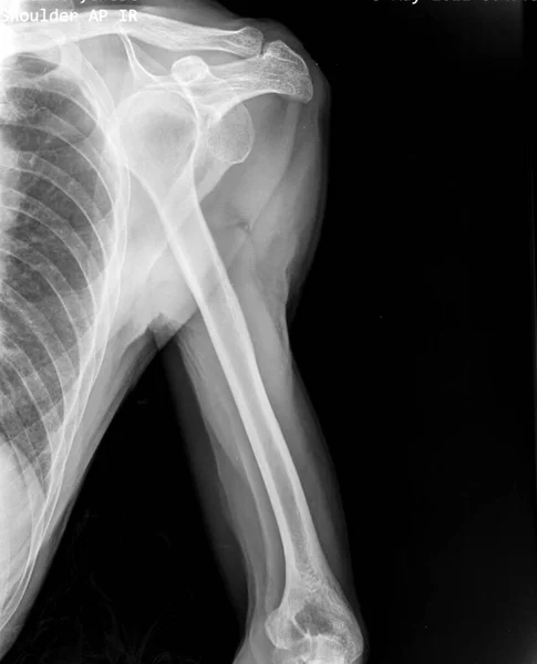 Рентгенівське Випромінювання Лівого Плеча — стокове фото