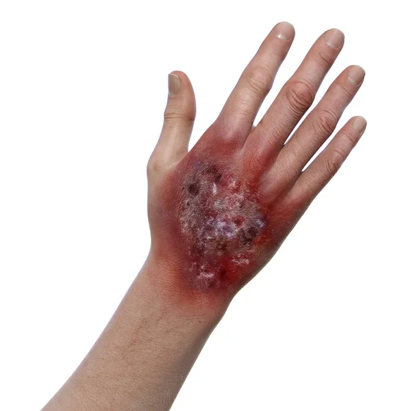 Μόλυνση Protothecosis Ένα Ανθρώπινο Χέρι Εικονογράφηση Υπολογιστή — Φωτογραφία Αρχείου