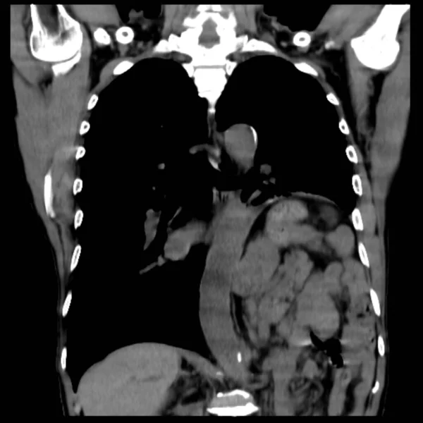 Tomografia Computadorizada Tórax Paciente Anos Idade Com Dor Torácica Mostrando — Fotografia de Stock