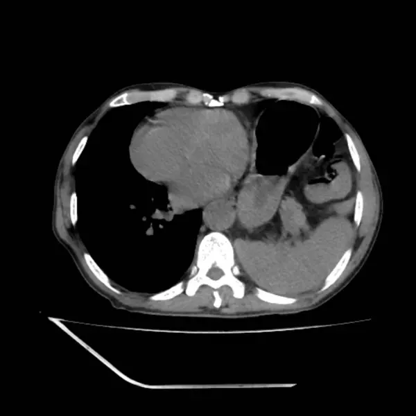1例50岁胸部疼痛患者胸部电脑断层扫描 显示左胸部间歇性疝 向右纵隔移位 间歇性疝是胃的一部分进入胸腔的突出物 — 图库照片