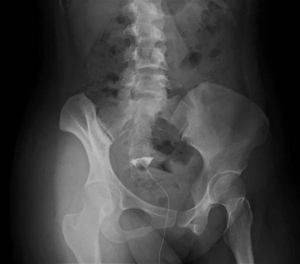 Radiografía Histerosalpingográfica Hsg Que Muestra Trompas Falopio Obstruidas Bilaterales Hsg —  Fotos de Stock