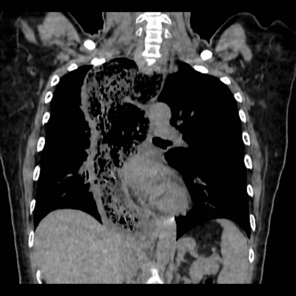 Tomografia Computadorizada Uma Paciente Sexo Feminino Anos Idade Com Dor — Fotografia de Stock
