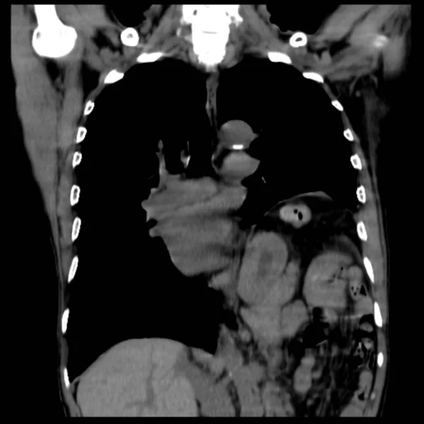 Göğüs Ağrısı Olan Yaşındaki Bir Hastanın Göğsünün Tomografisi Sol Göğsünde — Stok fotoğraf