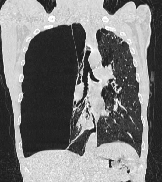 Yaşında Nefes Darlığı Çeken Bir Erkek Hastanın Göğüs Tomografisi Taraması — Stok fotoğraf