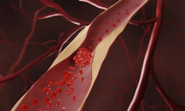 Coágulo Sangue Formando Uma Artéria Estreitada Ilustração Computador — Fotografia de Stock