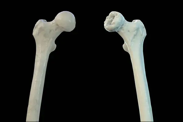 Computer Illustration Left Femur Bone Right Affected Legg Calve Perthes — Stock Photo, Image