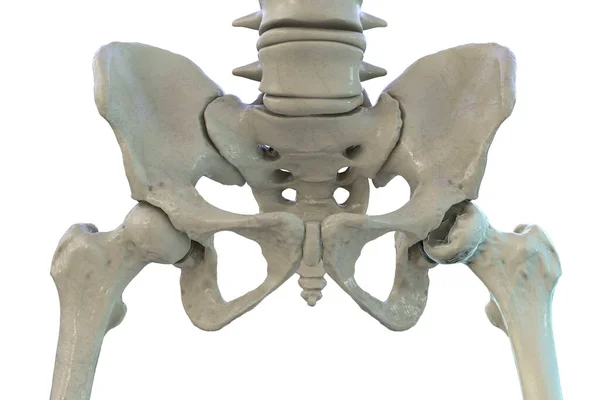 Ilustracja Komputerowa Lewej Kości Udowej Prawej Dotkniętej Chorobą Legg Calve — Zdjęcie stockowe