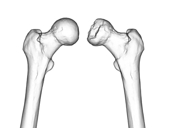 Ilustracja Komputerowa Lewej Kości Udowej Prawej Dotkniętej Chorobą Legg Calve — Zdjęcie stockowe