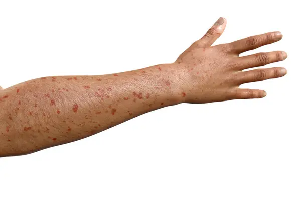 Hautausschlag Arm Eines Patienten Mit Marburger Hämorrhagischem Fieber Computerillustration — Stockfoto