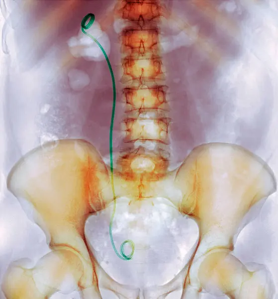 排尿器系のJjステント グリーンチューブ の着色X線 — ストック写真
