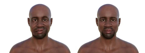 顔の麻痺のある健康な男と男 顔の片側の顔の筋肉の非対称性とドロップを強調するコンピュータイラスト — ストック写真