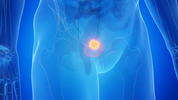 Cancro Bexiga Urinária Ilustração — Fotografia de Stock