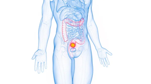 白い背景の直腸がん 3Dイラスト — ストック写真