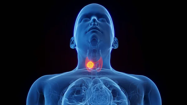 甲状腺癌 3D图像 黑色背景 — 图库照片