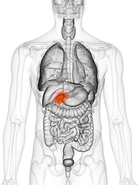Câncer Vesícula Biliar Ilustração — Fotografia de Stock