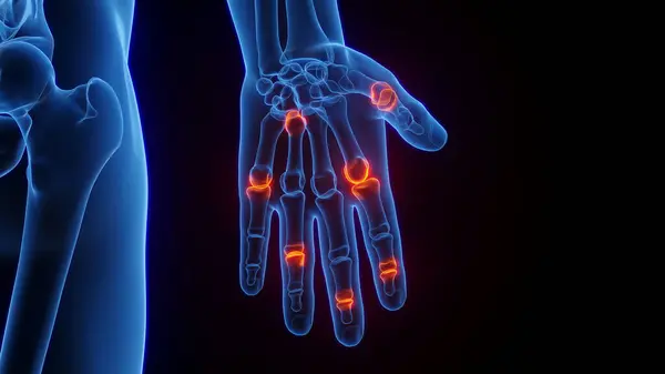 Inflamed Hand Illustration — Stock Photo, Image